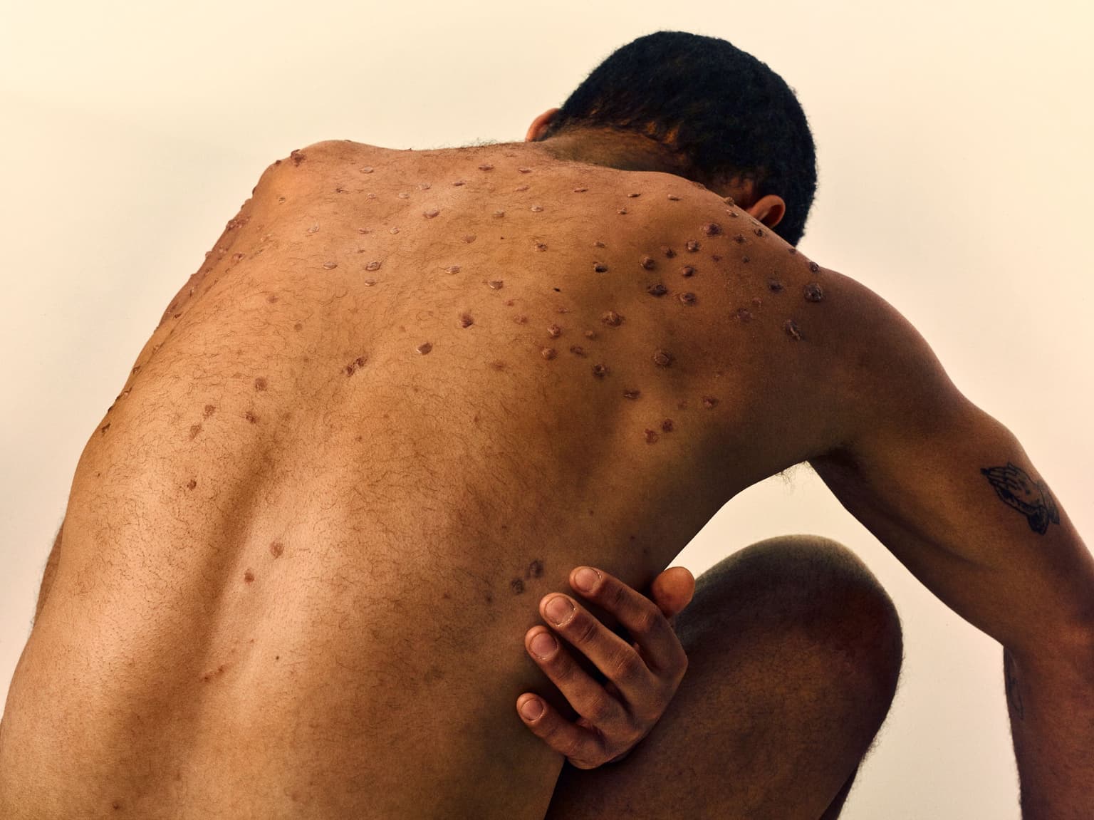 a mans naked back with skin lesions on it