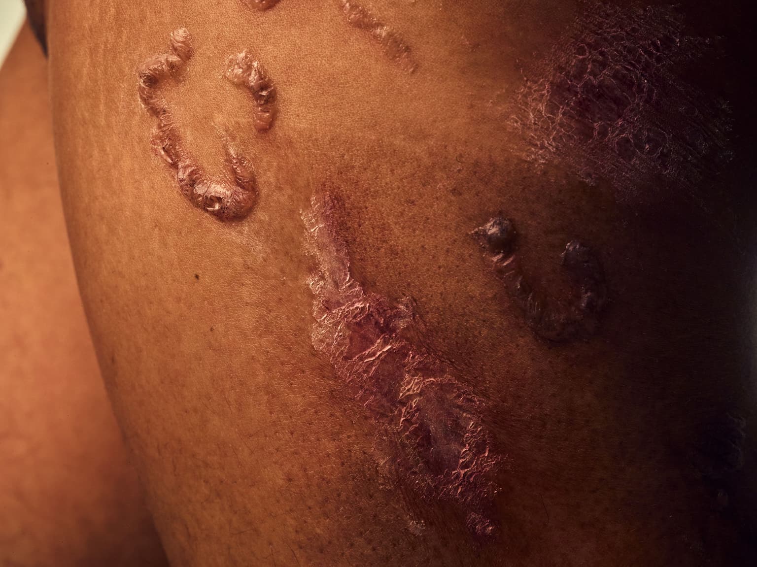 close up of skin disease