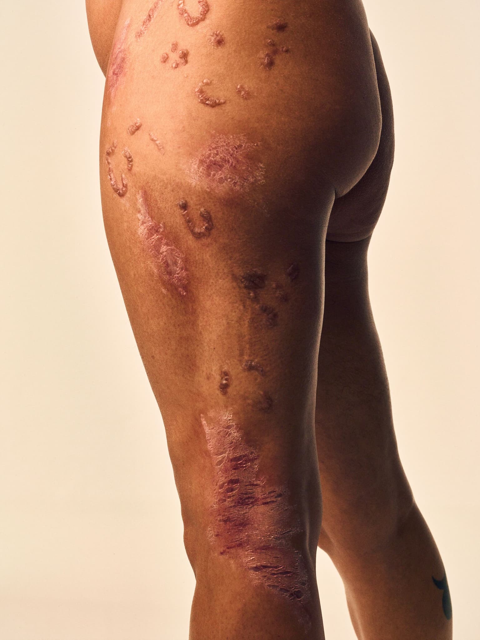 An image of a womans leg with skin diseases on it