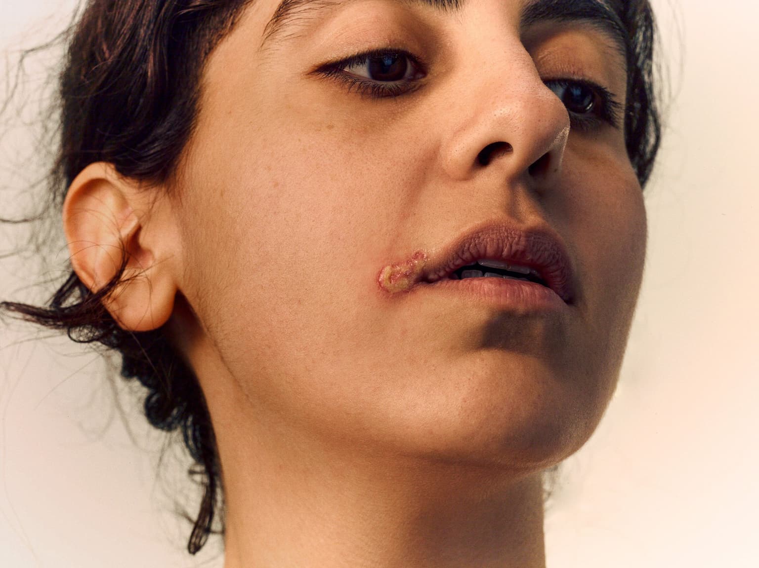 an image of a woman with a cold sore on her lip