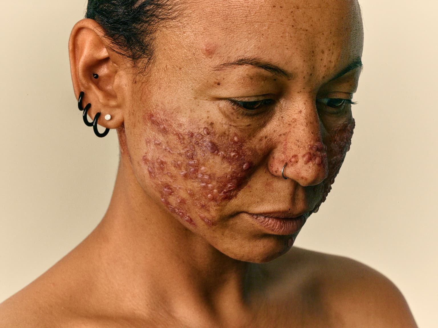 womans face with skin disease on it
