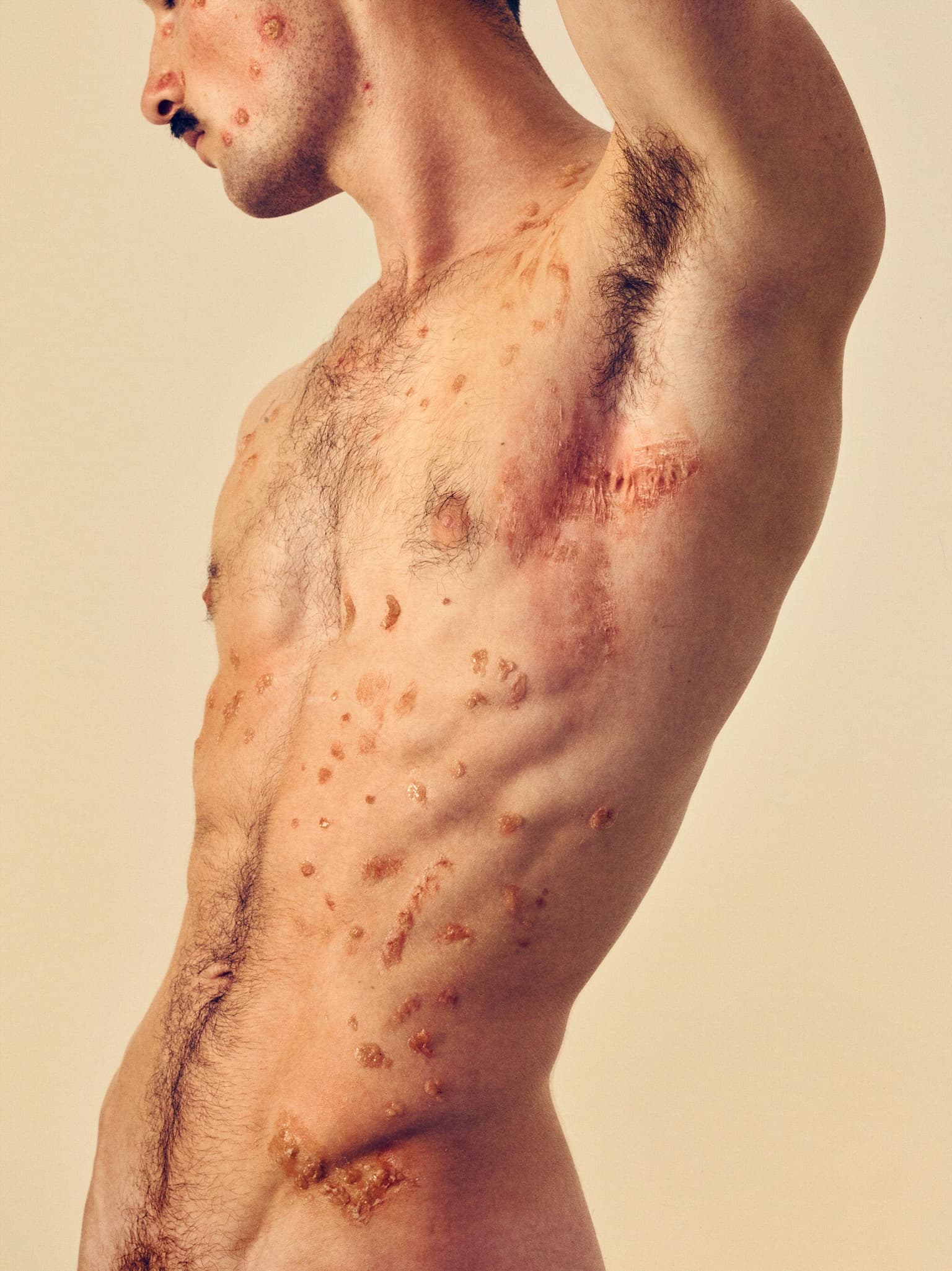 image of a muscly naked torso of a man with skin diseases on