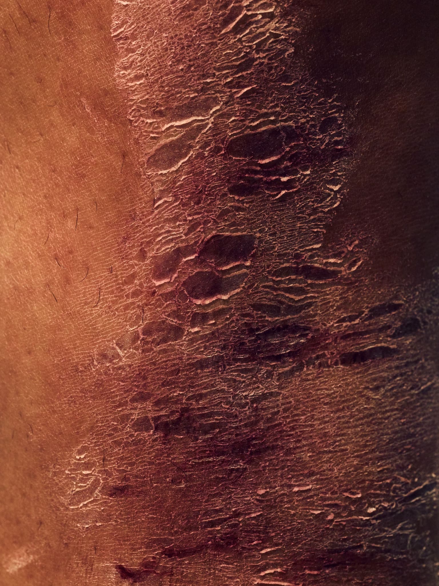 close up of skin disease
